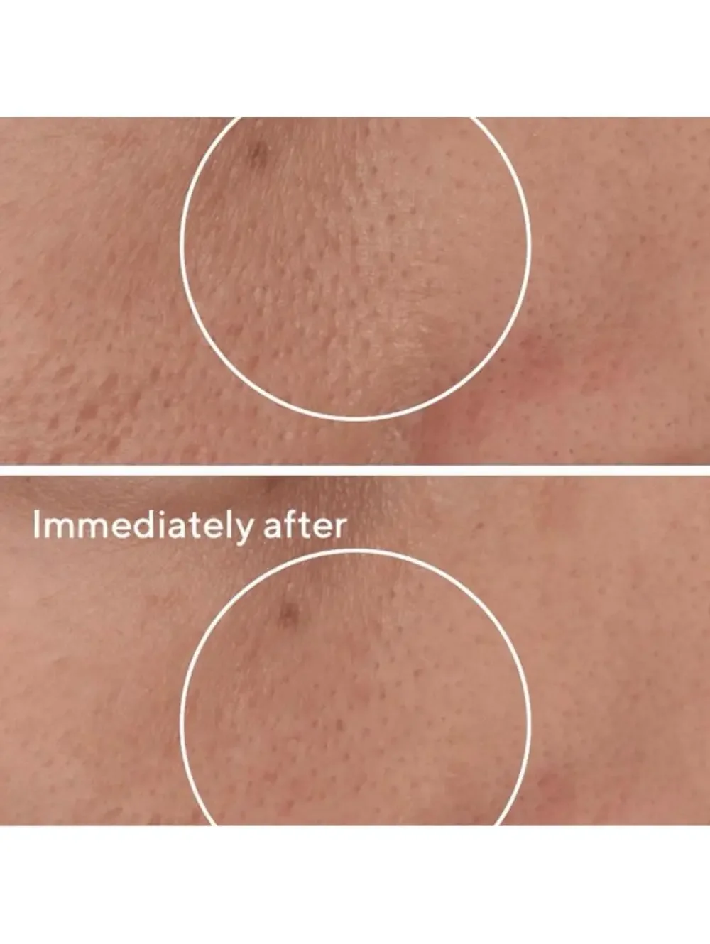New Murad Targeted Pore Refining Corrector